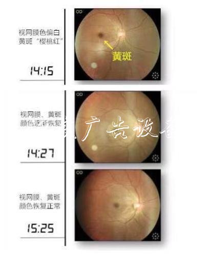 深圳30多歲IT男玩手機(jī)突戶外滾動(dòng)燈箱然失明 醫(yī)生：系眼球中風(fēng)